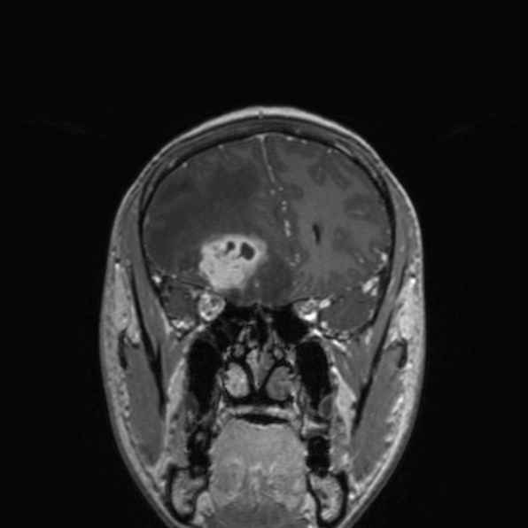Cerebral abscess (Radiopaedia 24212-24478 Coronal T1 C+ 71).jpg