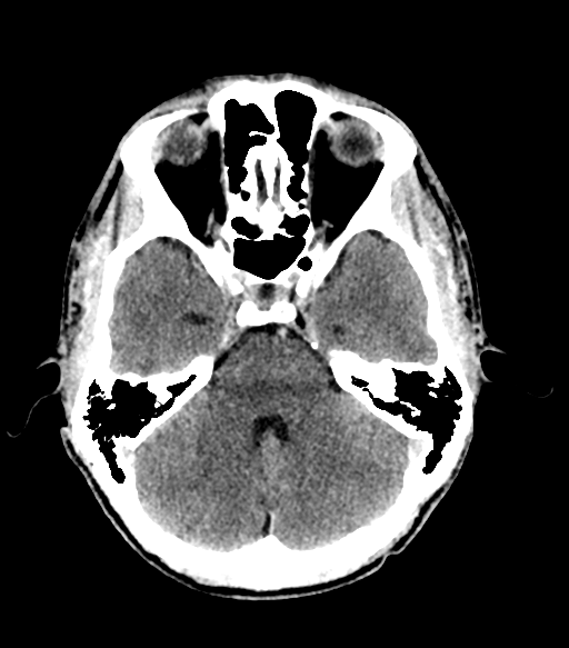 Cerebral abscess (Radiopaedia 57774-64741 Axial C+ delayed 25).png