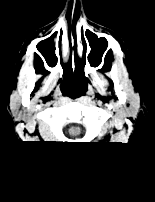 Cerebral abscess (Radiopaedia 60342-68008 Axial non-contrast 1).png