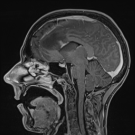 Cerebral abscess (Radiopaedia 60342-68009 J 30).png
