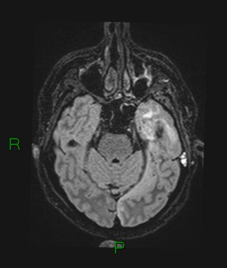 File:Cerebral abscess and subdural empyema (Radiopaedia 84436-99779 Axial FLAIR 59).jpg