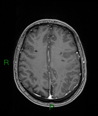 Cerebral abscess and subdural empyema (Radiopaedia 84436-99779 Axial T1 C+ 30).jpg