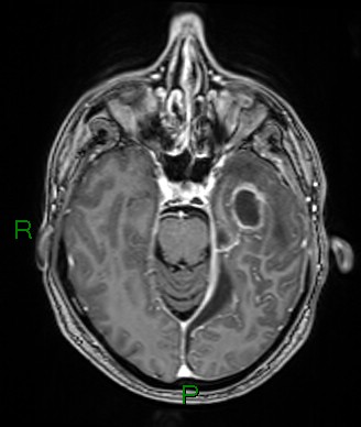 File:Cerebral abscess and subdural empyema (Radiopaedia 84436-99779 Axial T1 C+ 56).jpg