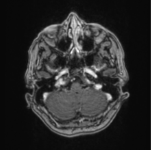 Cerebral abscess from pulmonary arteriovenous malformation (Radiopaedia 86275-102291 Axial T1 C+ 17).png