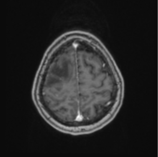 Cerebral abscess from pulmonary arteriovenous malformation (Radiopaedia 86275-102291 Axial T1 C+ 63).png