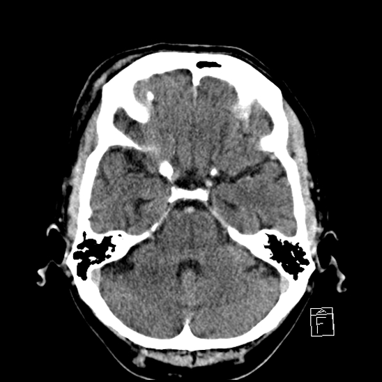 File:Cerebral abscess with ventriculitis (Radiopaedia 78965-91877 A 15).jpg