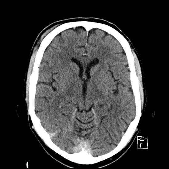 File:Cerebral abscess with ventriculitis (Radiopaedia 78965-91877 A 22).jpg