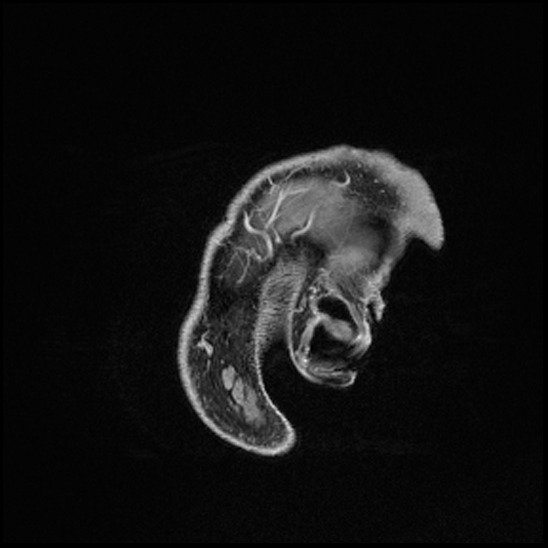 Cerebral abscess with ventriculitis (Radiopaedia 78965-91878 Sagittal T1 C+ 175).jpg