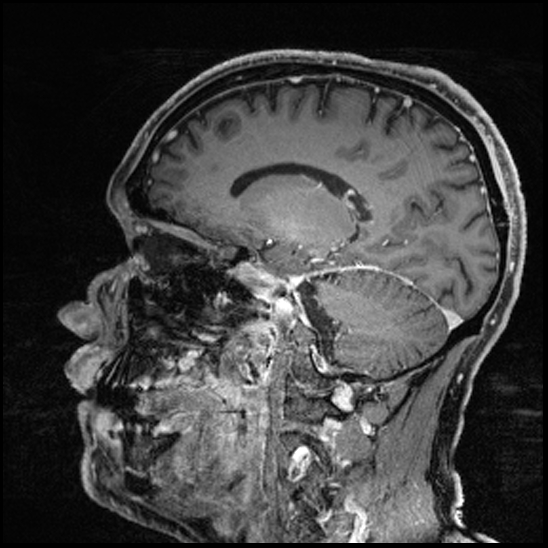 Cerebral abscess with ventriculitis (Radiopaedia 78965-91878 Sagittal T1 C+ 74).jpg