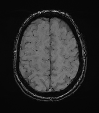 Cerebral amyloid angiopathy (Radiopaedia 46082-50433 Axial SWI 65).png