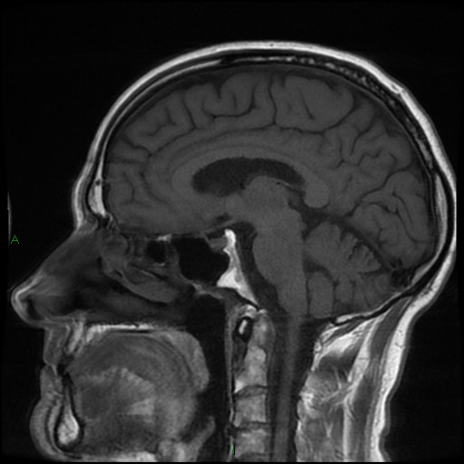 File:Cerebral amyloid angiopathy (Radiopaedia 77506-89664 Coronal T1 15).jpg