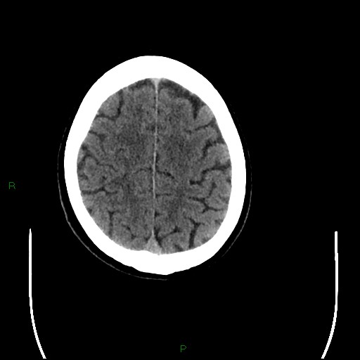 File:Cerebral amyloid angiopathy (Radiopaedia 77506-89665 Axial non-contrast 88).jpg