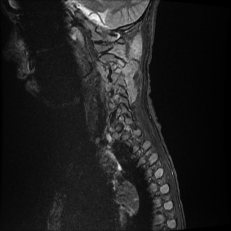 File:Cerebral and spinal tuberculosis (Radiopaedia 90489-107838 Sagittal STIR 11).jpg