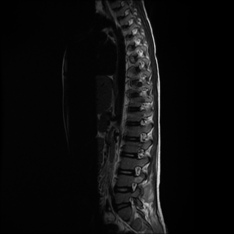 File:Cerebral and spinal tuberculosis (Radiopaedia 90489-107912 Sagittal T2 3).jpg