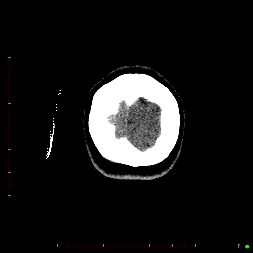File:Cerebral arteriovenous malformation (AVM) (Radiopaedia 78162-90706 Coronal non-contrast 95).jpg
