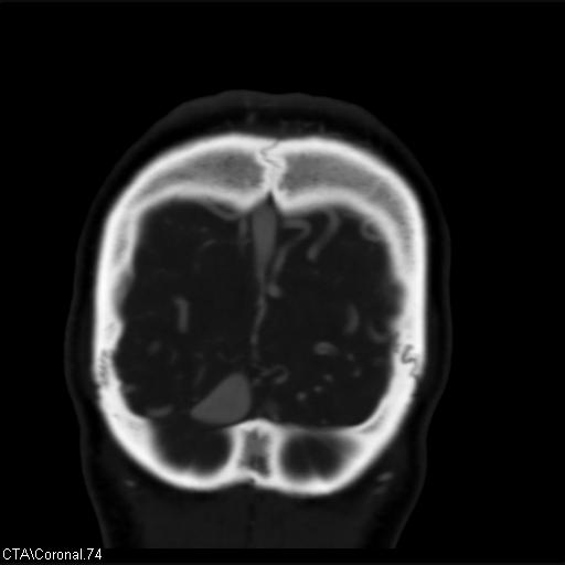 Cerebral arteriovenous malformation (Radiopaedia 28518-28759 C 74).jpg