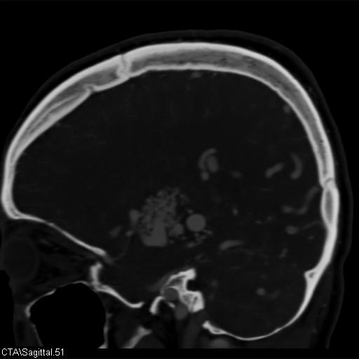 Cerebral arteriovenous malformation (Radiopaedia 28518-28759 D 48).jpg