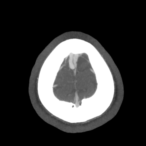 Cerebral arteriovenous malformation (Radiopaedia 39259-41505 AX CEREBRAL CTA 55).png