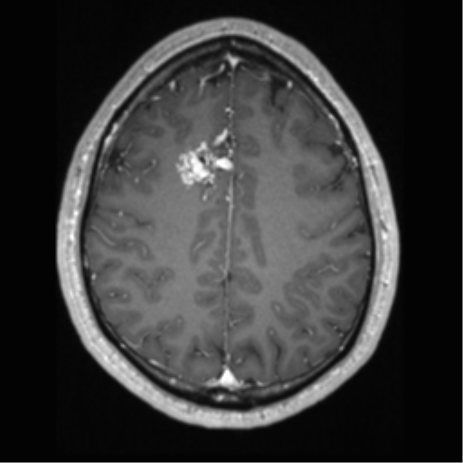 File:Cerebral arteriovenous malformation (Radiopaedia 39259-41506 AX T1 MPR C+ 51).png
