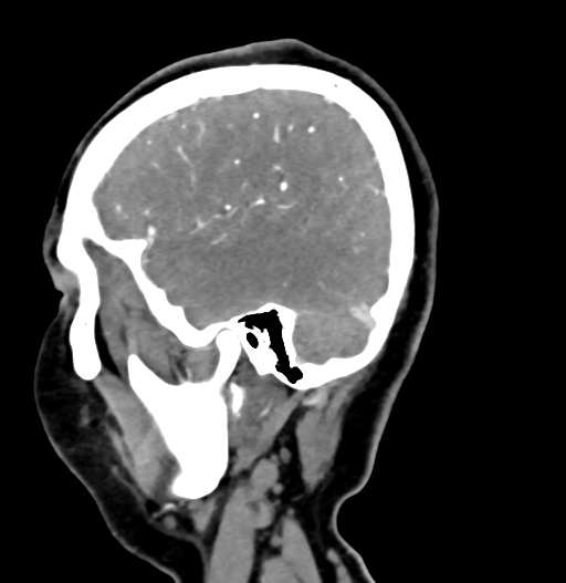 Cerebral arteriovenous malformation (Radiopaedia 73830-84645 D 75).jpg