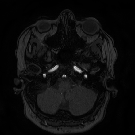Cerebral arteriovenous malformation (Radiopaedia 74411-85654 Axial MRA 9).jpg