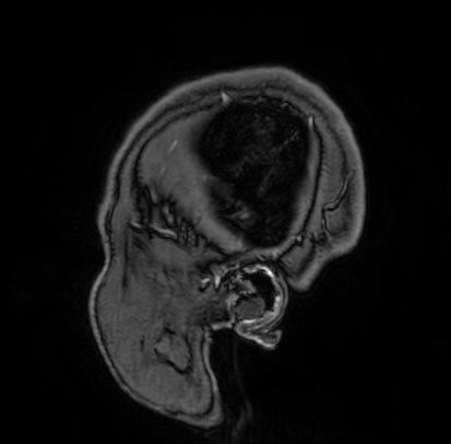 Cerebral arteriovenous malformation (Radiopaedia 74411-85654 Sagittal T1 C+ 2).jpg
