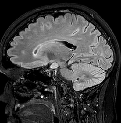 Cerebral arteriovenous malformation (Radiopaedia 74411-85746 Sagittal FLAIR 45).jpg
