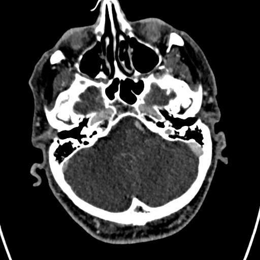 Cerebral arteriovenous malformation (Radiopaedia 78188-90746 Axial C+ delayed 37).jpg