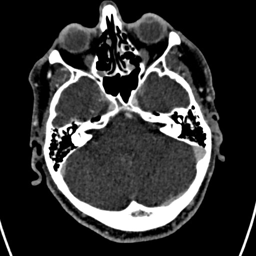 Cerebral arteriovenous malformation (Radiopaedia 78188-90746 Axial C+ delayed 45).jpg