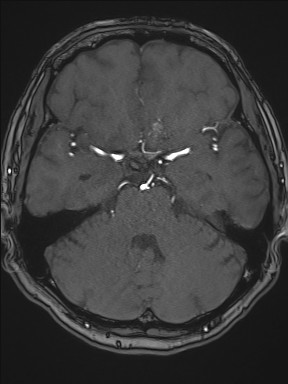 File:Cerebral arteriovenous malformation (Radiopaedia 84015-99245 Axial TOF 94).jpg