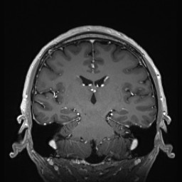 Cerebral arteriovenous malformation (Radiopaedia 84015-99245 Coronal T1 C+ 90).jpg