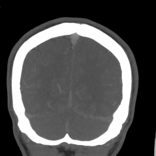 Cerebral arteriovenous malformation (Spetzler-Martin grade 2) (Radiopaedia 41262-44076 F 53).png