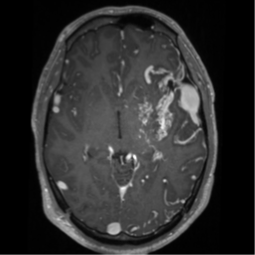 Cerebral arteriovenous malformation - huge (Radiopaedia 35734-37272 Axial T1 C+ 32).png