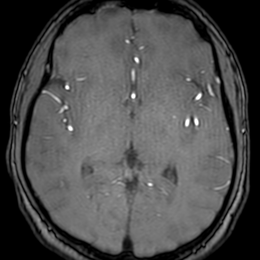Cerebral arteriovenous malformation at posterior body of corpus callosum (Radiopaedia 74111-84925 Axial MRA 109).jpg