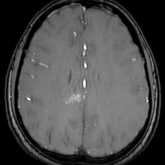 Cerebral arteriovenous malformation at posterior body of corpus callosum (Radiopaedia 74111-84925 Axial MRA 148).jpg