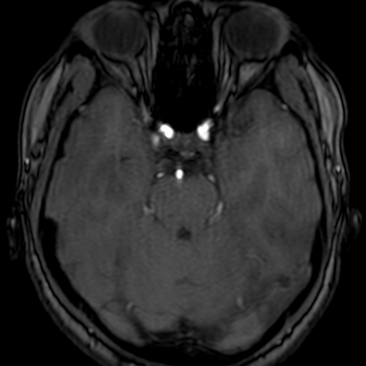 Cerebral arteriovenous malformation at posterior body of corpus callosum (Radiopaedia 74111-84925 Axial MRA 65).jpg