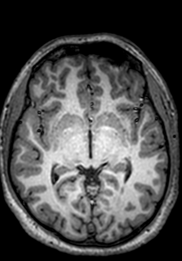 Cerebral arteriovenous malformation at posterior body of corpus callosum (Radiopaedia 74111-84925 Axial T1 163).jpg
