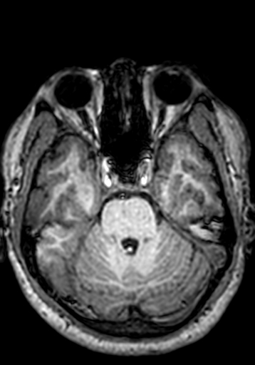 Cerebral arteriovenous malformation at posterior body of corpus callosum (Radiopaedia 74111-84925 Axial T1 218).jpg