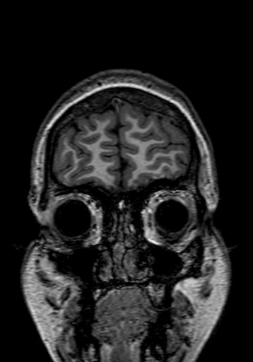 Cerebral arteriovenous malformation at posterior body of corpus callosum (Radiopaedia 74111-84925 Coronal T1 16).jpg