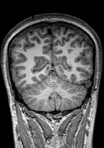 Cerebral arteriovenous malformation at posterior body of corpus callosum (Radiopaedia 74111-84925 Coronal T1 265).jpg