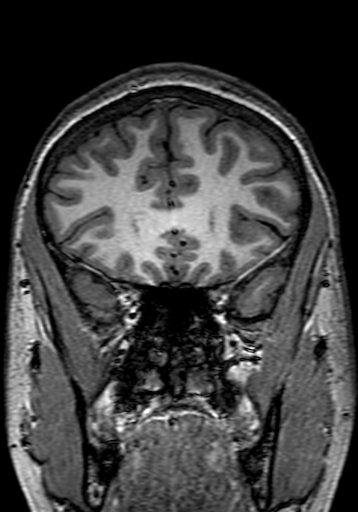 Cerebral arteriovenous malformation at posterior body of corpus callosum (Radiopaedia 74111-84925 Coronal T1 78).jpg