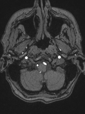 Cerebral arteriovenous malformation with hemorrhage (Radiopaedia 34422-35737 Axial MRA 7).png