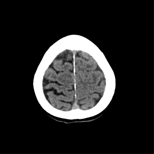 File:Cerebral arteriovenous malformation with lobar hemorrhage (Radiopaedia 44725-48510 Axial non-contrast 35).png