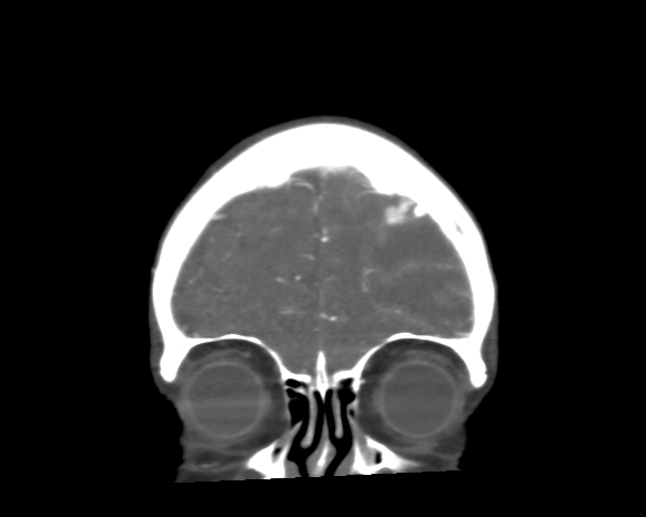 File:Cerebral arteriovenous malformation with lobar hemorrhage (Radiopaedia 44725-48511 A 10).png