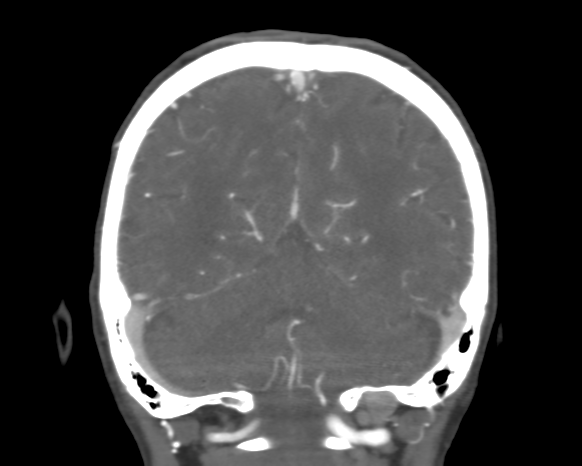 Cerebral arteriovenous malformation with lobar hemorrhage (Radiopaedia 44725-48511 A 43).png