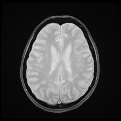 File:Cerebral autosomal dominant arteriopathy with subcortical infarcts and leukoencephalopathy (CADASIL) (Radiopaedia 41018-43768 Ax 2D MERGE 13).png