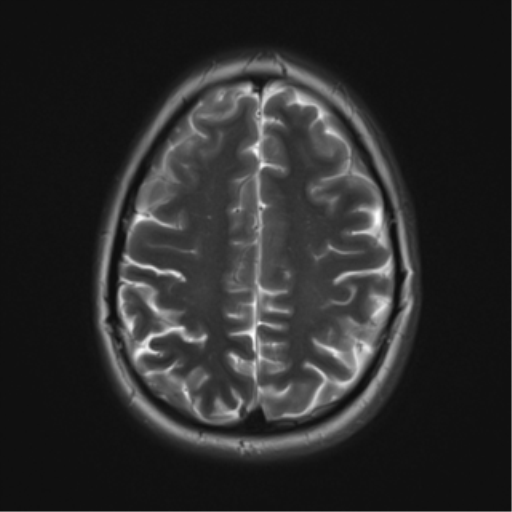 File:Cerebral cavernoma and development venous anomaly (Radiopaedia 37603-39482 Axial T2 17).png