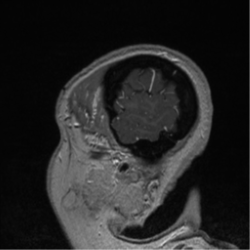 Cerebral cavernoma and development venous anomaly (Radiopaedia 37603-39482 Sagittal T1 C+ 85).png