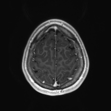 Cerebral cavernous venous malformation (Radiopaedia 70008-80021 Axial T1 C+ 88).jpg