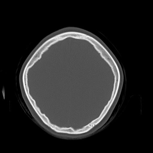 Cerebral cavernous venous malformation (Radiopaedia 70008-80022 Axial bone window 41).jpg